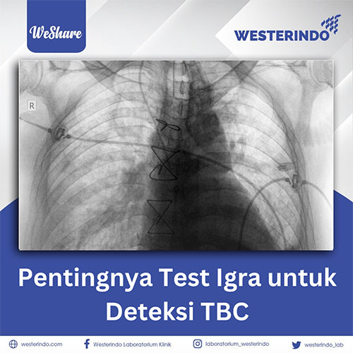 Pentingnya Test Igra untuk Deteksi TBC