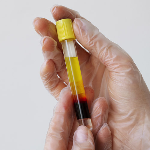 Apa Itu Platelet Rich Plasma (PRP) ?