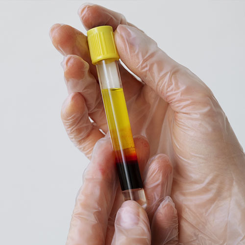 Platelet Rich Plasma / PRP Digunakan untuk Kondisi Apa Saja?