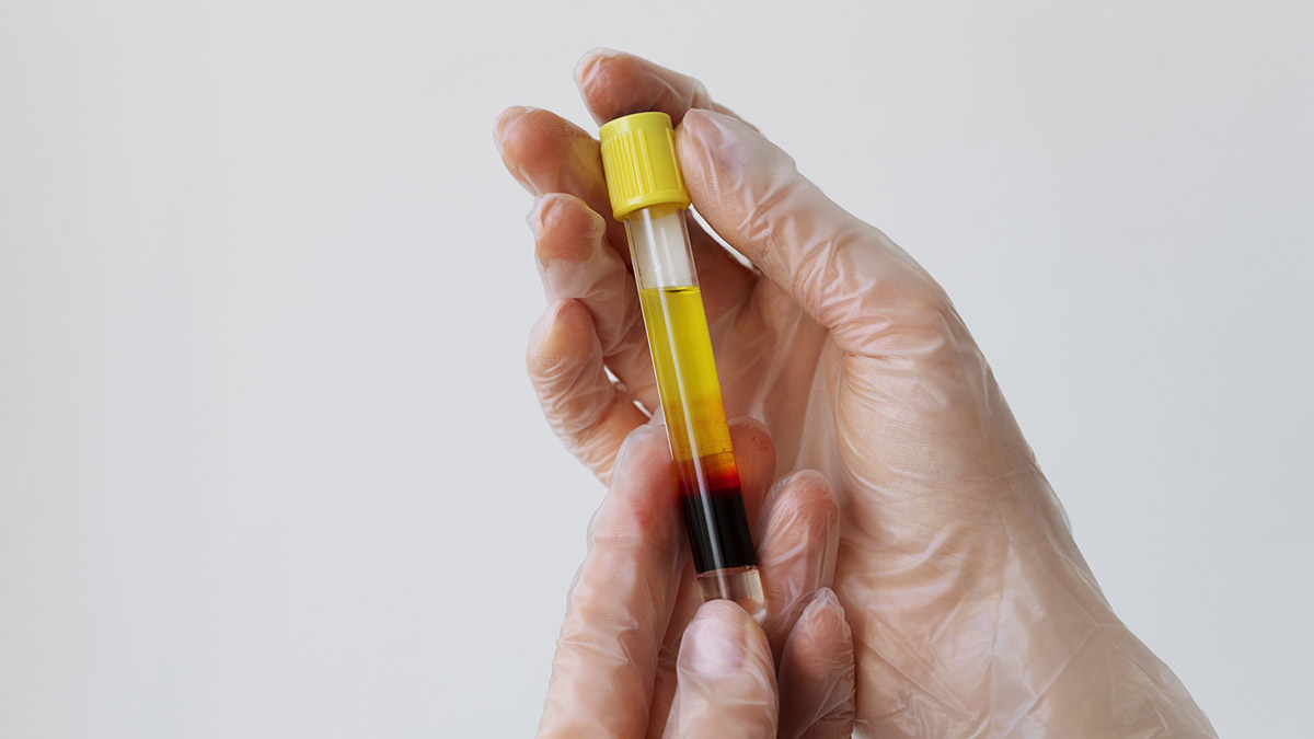 Apa Itu Platelet Rich Plasma (PRP) ?