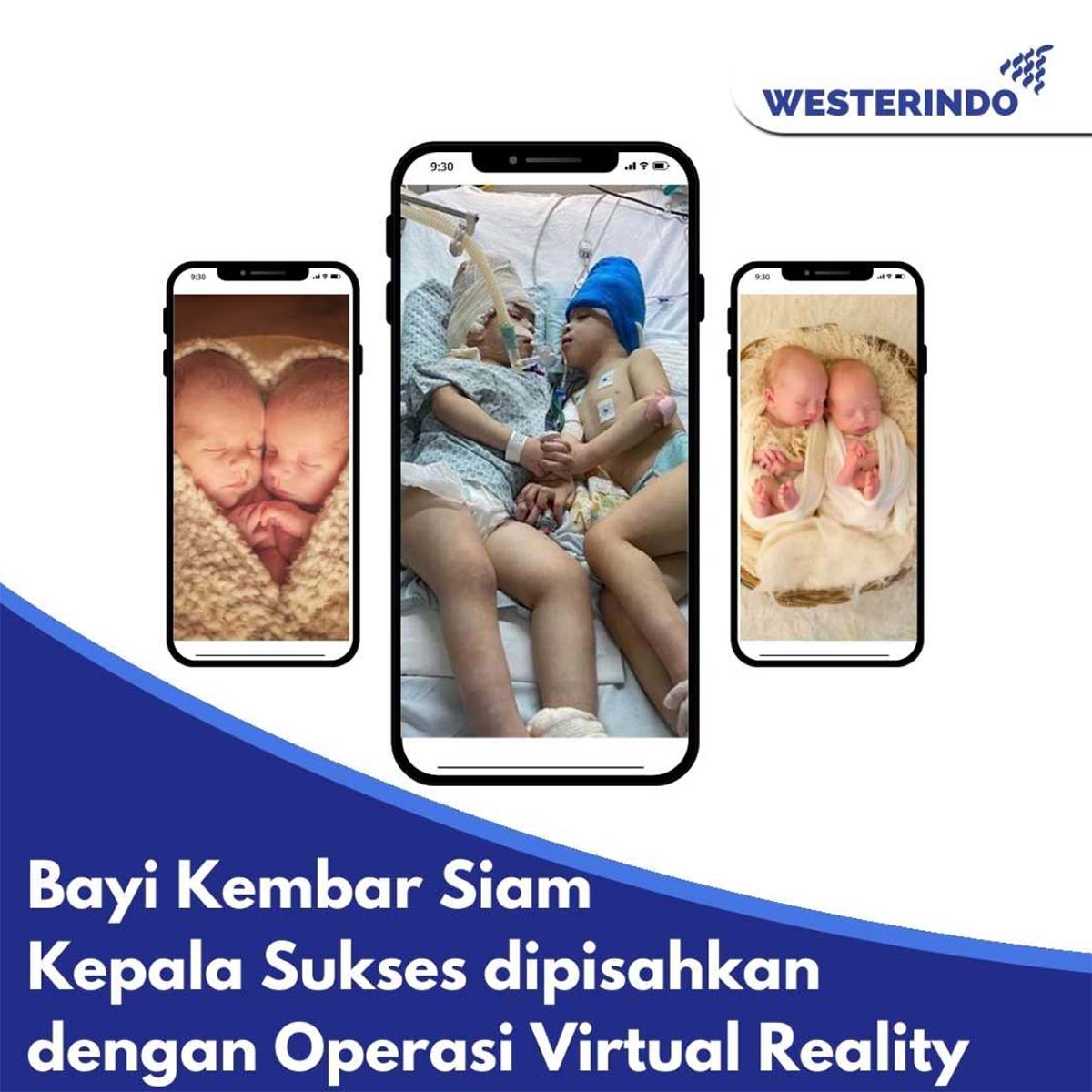 Kembar Siam Kepala Sukses dipisahkan