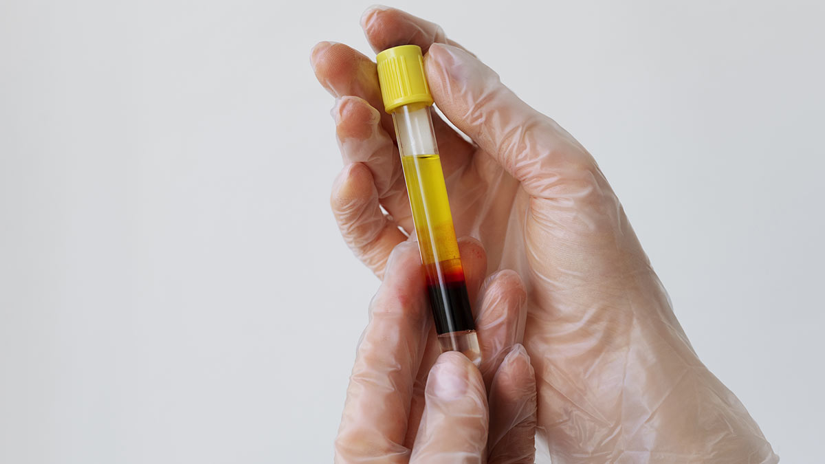 Platelet Rich Plasma / PRP Digunakan untuk Kondisi Apa Saja?