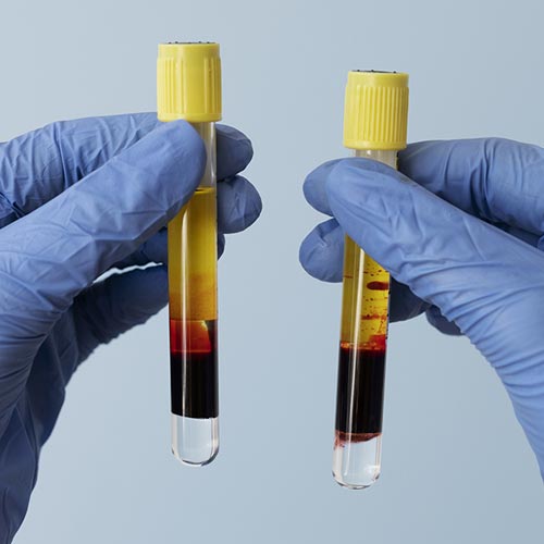 Platelet Rich Plasma / PRP: Seperti Ini Prosedur Lengkapnya