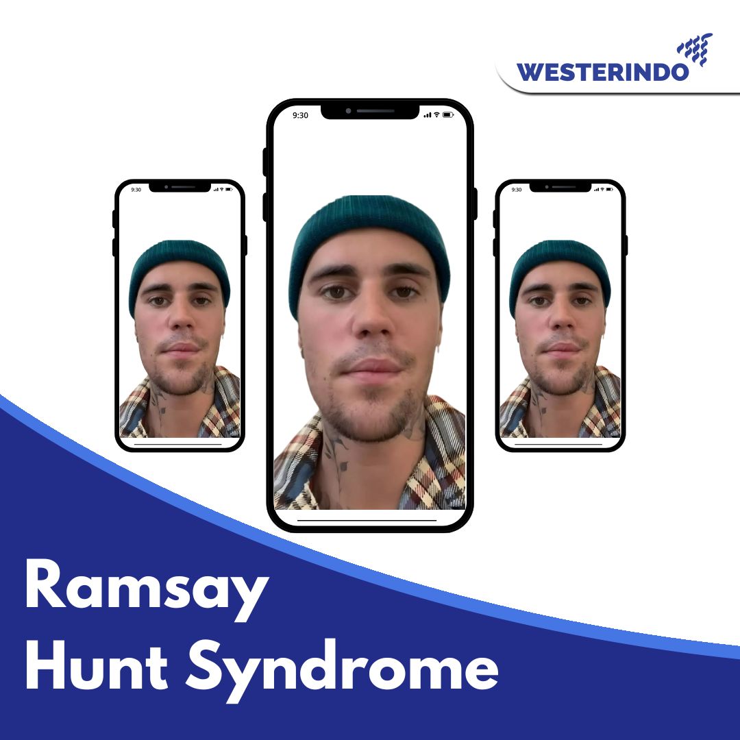 Ramsay Hunt Syndrome